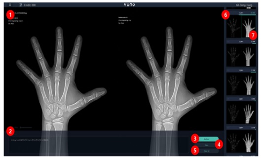 작동원리 : 환자의 좌측 X-ray 영상의 패턴을 인식하여 소프트웨어 화면 상 우측에 제시되어 있는 GP 참조표준영상(남 31개, 여 27개)의 패턴과 유사성을 분석하여 전구간 표준영상에 유사 확률을 표시.임상의는 환자 영상과 소프트웨어를 통해 제시된 해당 확률 등을 고려하여 환자의 뼈나이를 판독