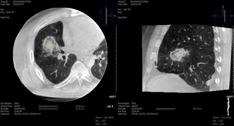 ■ 대장암 폐 전이 고주파 열 치료 시술직후 cone beam CT.