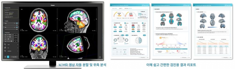 가천대 <span class='searchWord'>길병원</span> VIP건강증진센터가 인공지능을 이용한 파킨슨·치매 건강검진 프로그램을 도입했다. 뇌MRI 검사로 파킨슨 여부를 가늠하고, 알츠하이머 진단을 위한 뇌 위축도를 확인할 수 있는 게 특징이다. 사진은 뇌 MRI 영상검사 자료와  결과 분석지 견본.