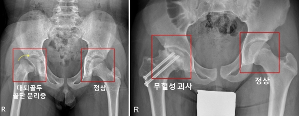 우측 고관절에 대퇴골두 골단 분리증(사진 왼쪽) 및 무혈성 괴사(사진 오른쪽)가 발생한 소아청소년 환자의 X-ray. ⓒ의협신문