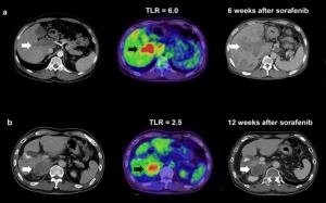 PET-CT 검사로 표적항암제 치료 결과 예측