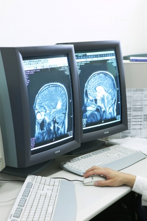 IT기업 유노믹은 MRI 영상·문진 등 데이터 4만개를 인공지능(AI)으로 분석해 초기 치매를 진단할 수 있는 기술이 91%이상의 정확도를 나타냈다고 밝혔다.