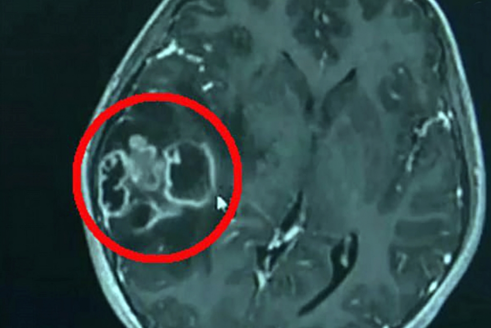 뇌병변 환자의 자기공명영상(MRI) 이미지. 임상적 징후·증상 그리고 여러 진단검사 결과를 같이 고려한 결과, 이 환자는 뇌농양으로 밝혀졌다. ⓒ의협신문