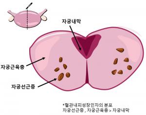 심한 생리통·난임 유발 '자궁선근증'…'혈관내피성장인자' 때문